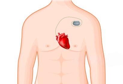 Cardiac Resynchronization Therapy (CRT)